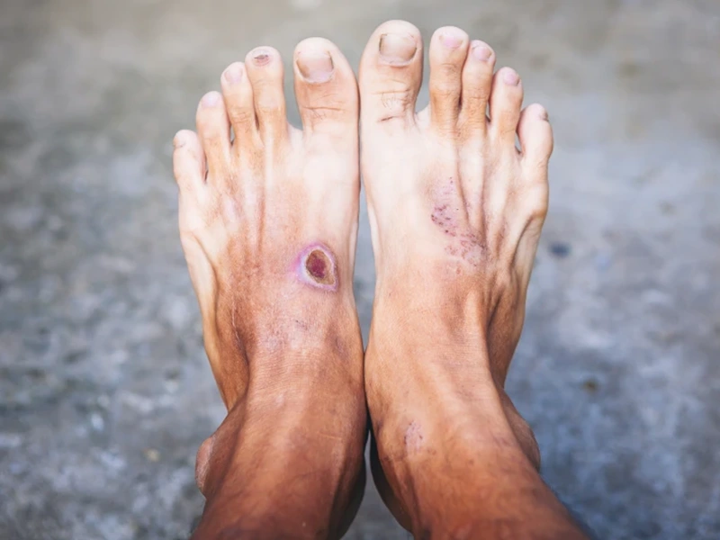 diabetic foot